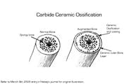Illustration of the Carbide Ceramic Ossification.