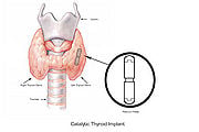 Illustration of the Catalytic Thyroid Implant.